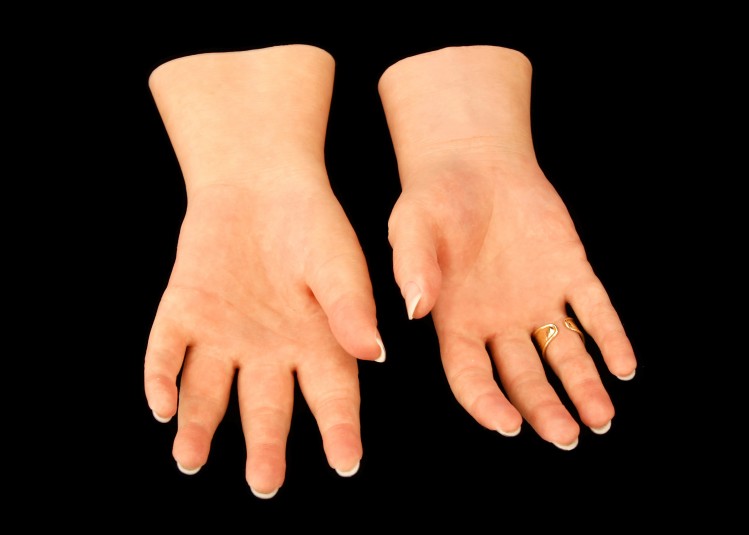 Palm side of the left and right cosmetic hands, with a gold ring on the right ring finger.