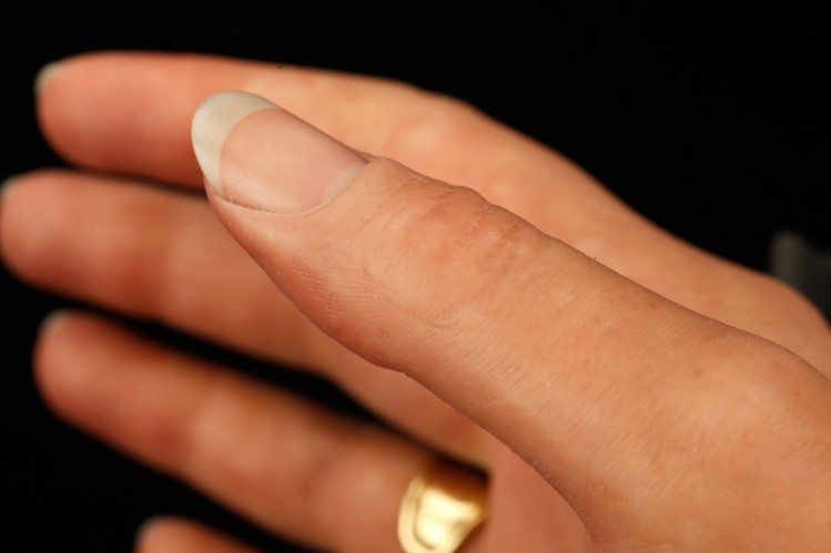 Close-up of thumb and fingernail of right cosmetic hand, with other fingers and ring visible in background.