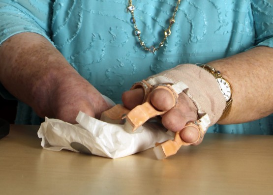 A close up of Cindy using the 3D printed fingers to wrap a gift, in white tissue paper. The fingers are attached to her hand via a woven elastic bandage on her wrists. The tips of three of Cindy's residual fingers are poking through the finger holes, and the tiny crystal decorative element is visible on each digit. The white food-grade silicone, enabling some flexibility and grip,  fills the ends of each digit.