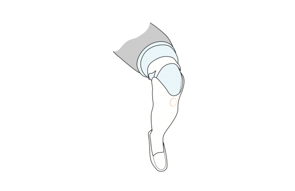 A technical drawing of Cindy's lower leg, with a circle showing the placement of the sponge for maximal cushioning.